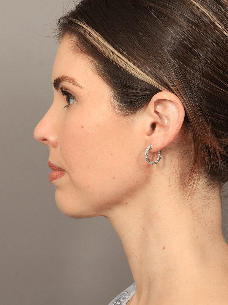 Face Liposuction Before & After