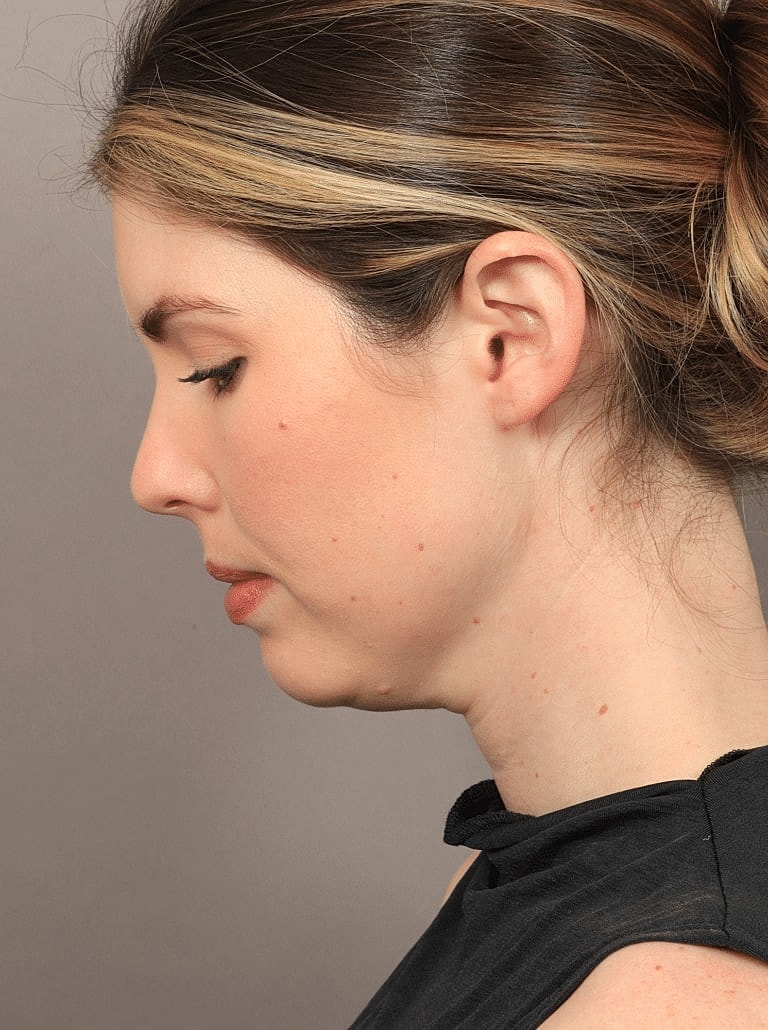 Face Liposuction Before & After