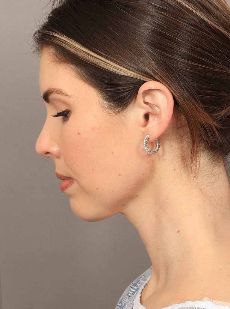 Face Liposuction Before & After