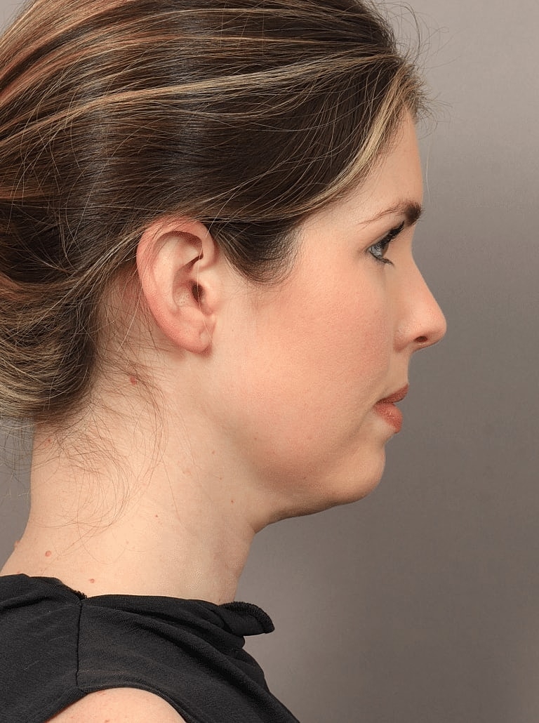 Face Liposuction Before & After