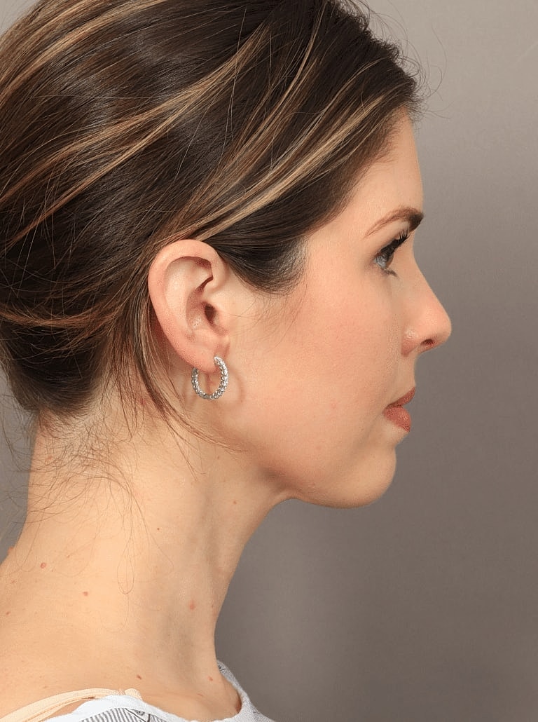 Face Liposuction Before & After