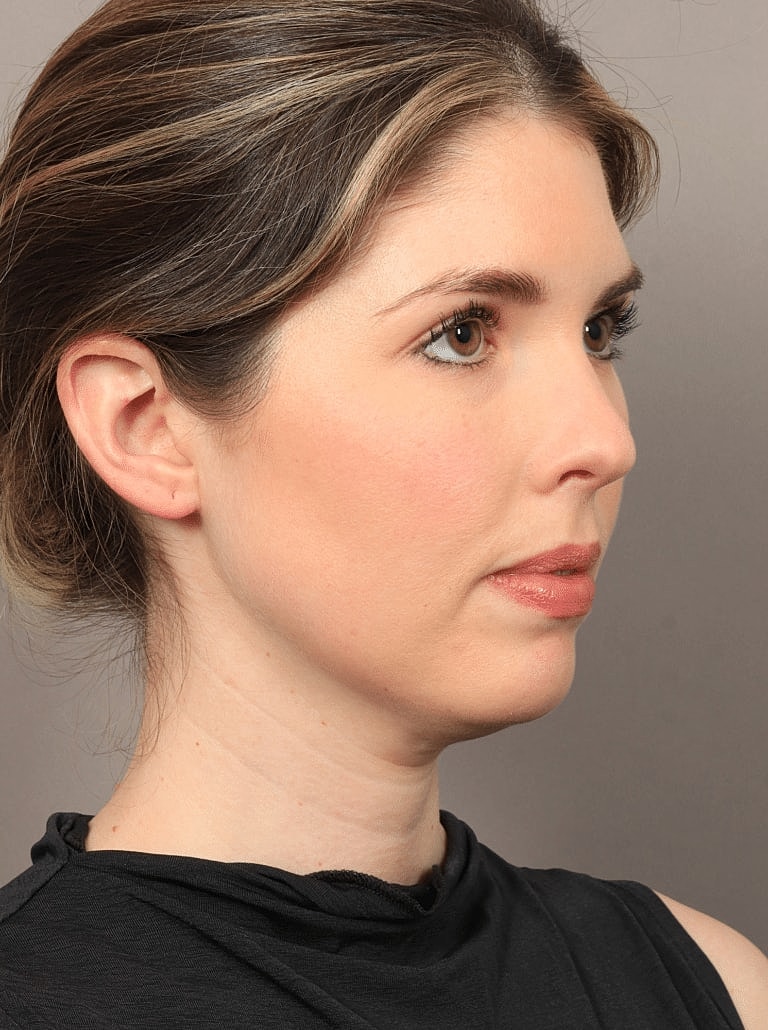 Face Liposuction Before & After