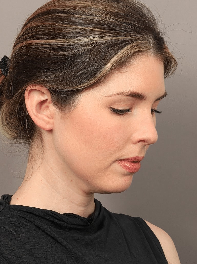 Face Liposuction Before & After