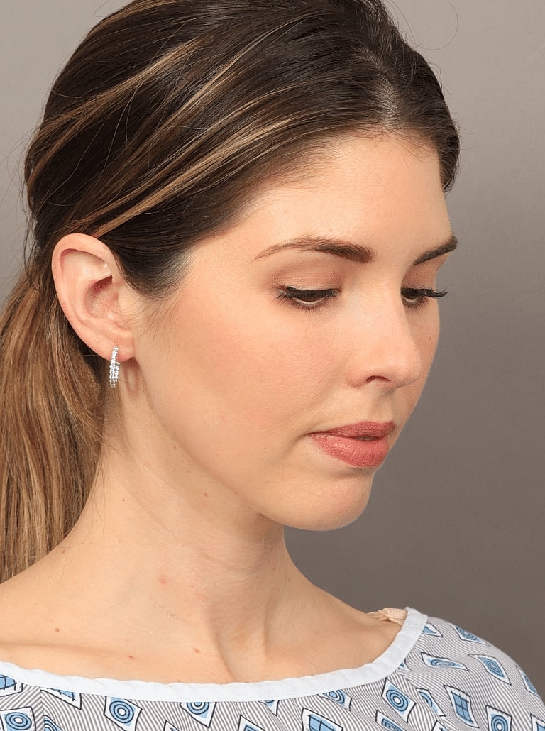 Face Liposuction Before & After