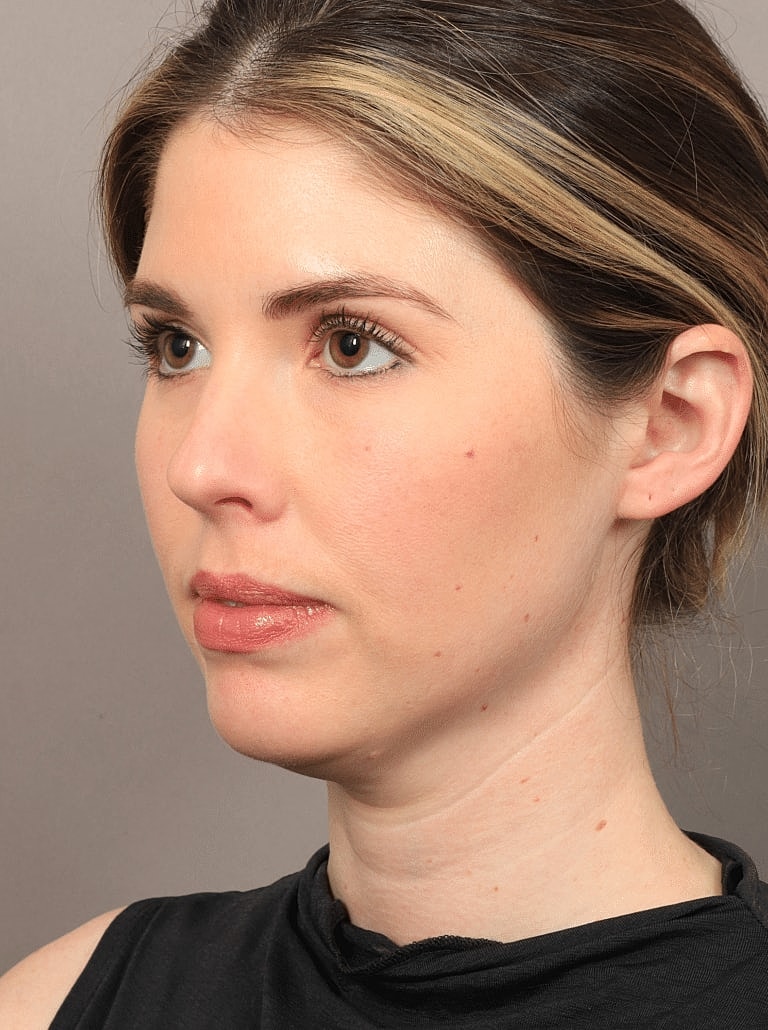 Face Liposuction Before & After