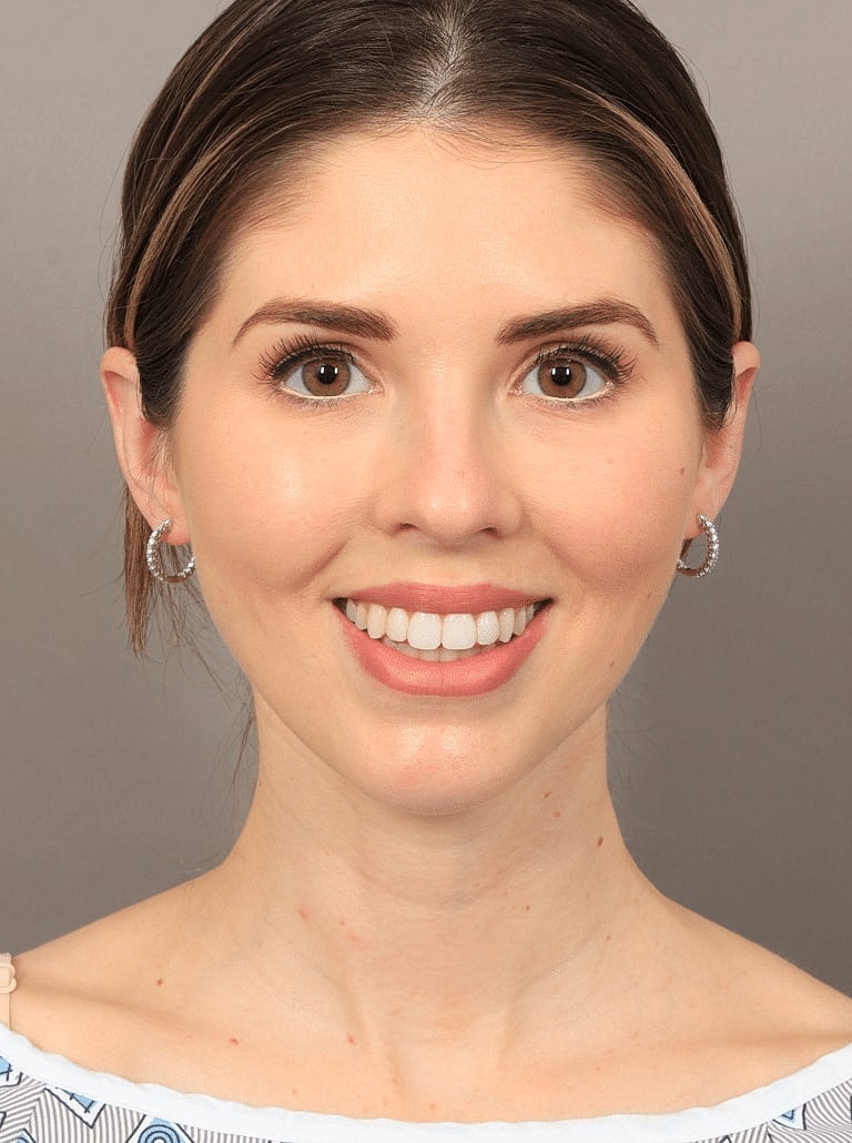 Face Liposuction Before & After