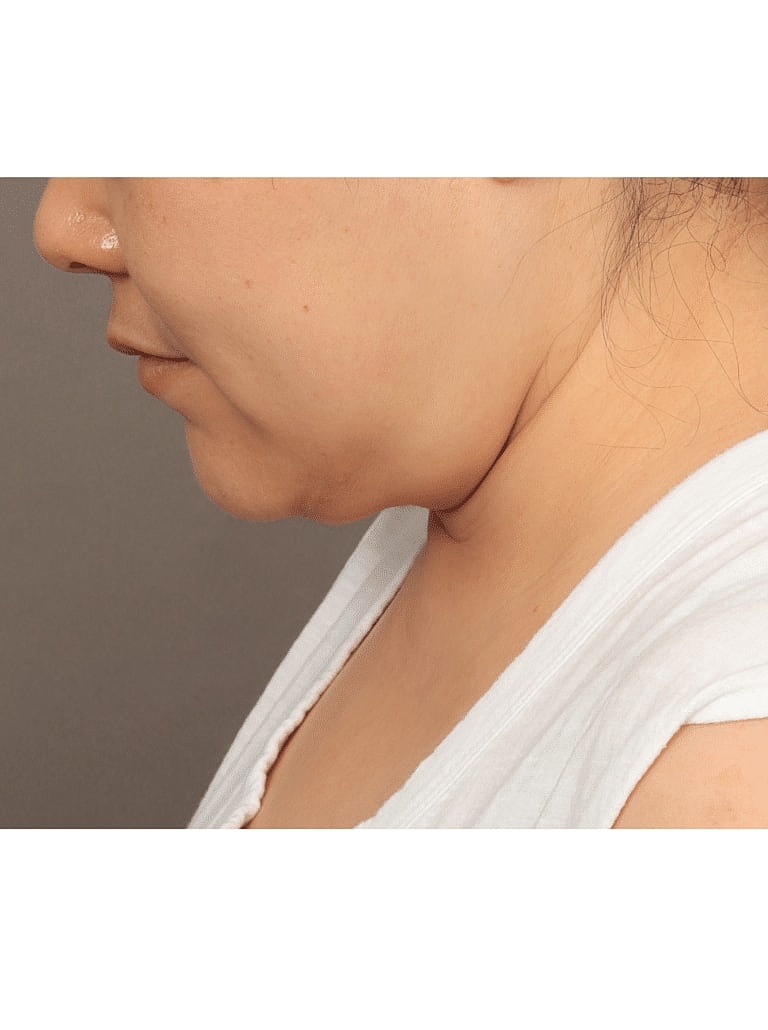 Face Liposuction Before & After