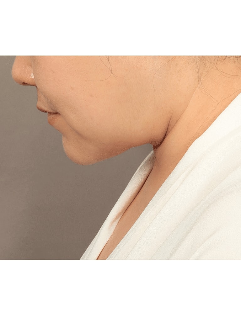 Face Liposuction Before & After