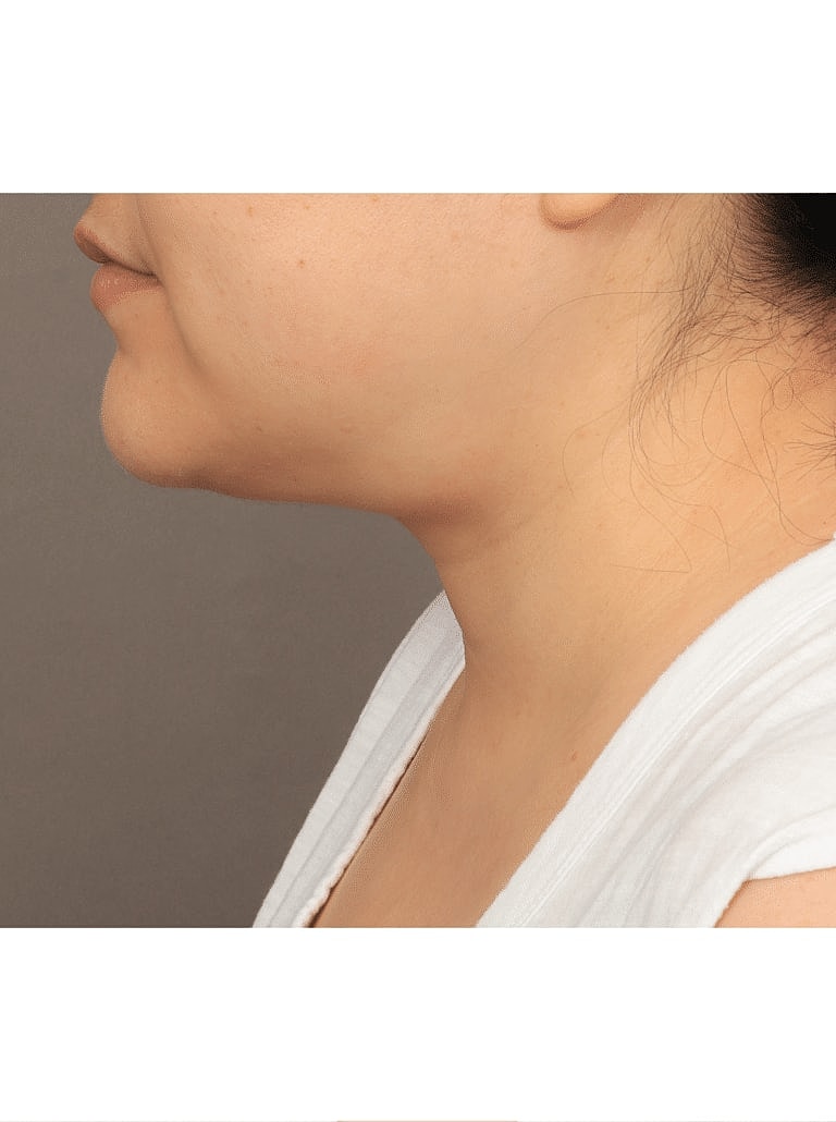 Face Liposuction Before & After