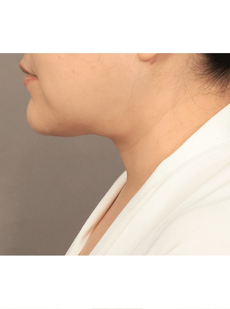 Face Liposuction Before & After