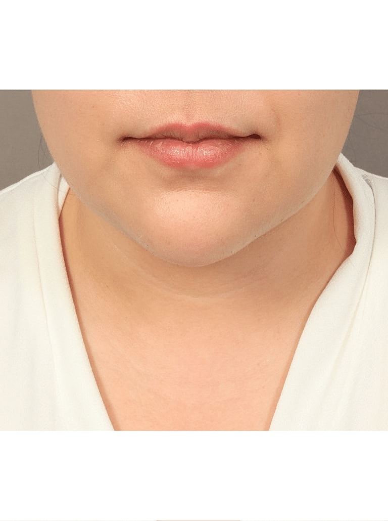 Face Liposuction Before & After