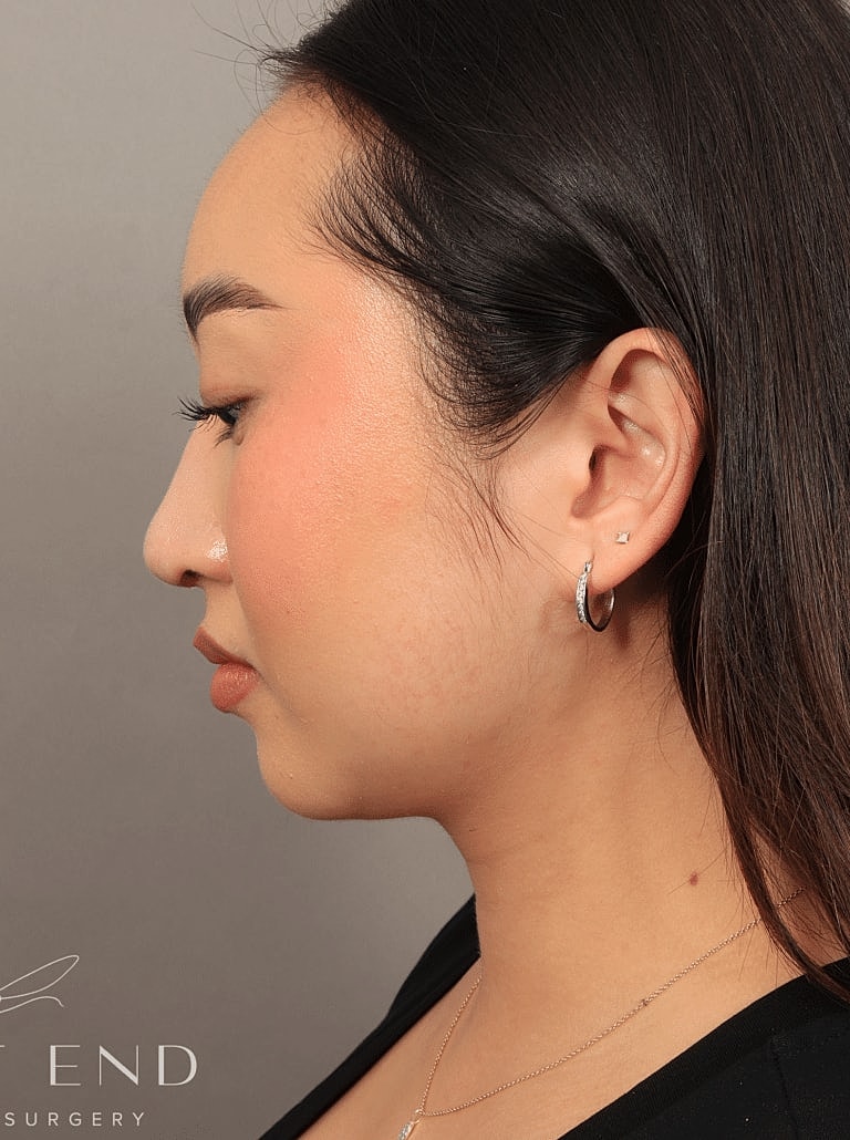 Face Liposuction Before & After
