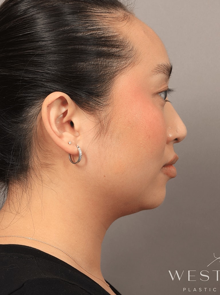Face Liposuction Before & After