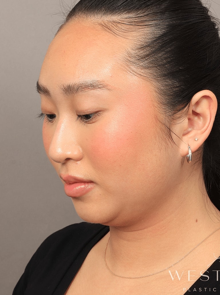 Face Liposuction Before & After