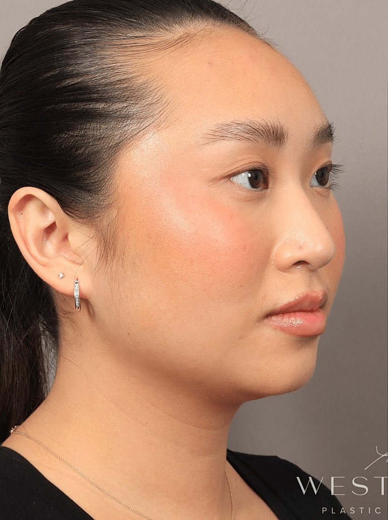 Face Liposuction Before & After
