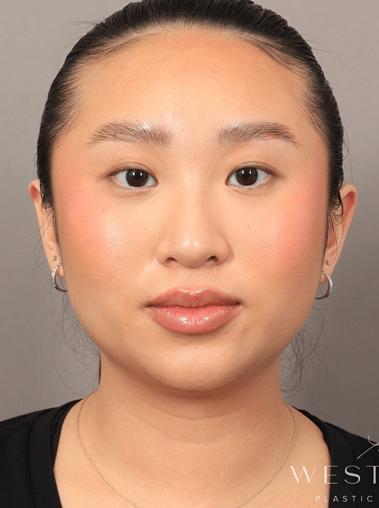 Face Liposuction Before & After