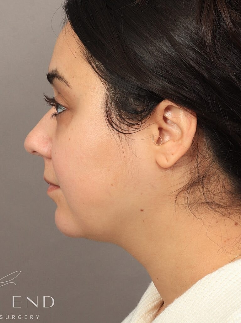 Face Liposuction Before & After