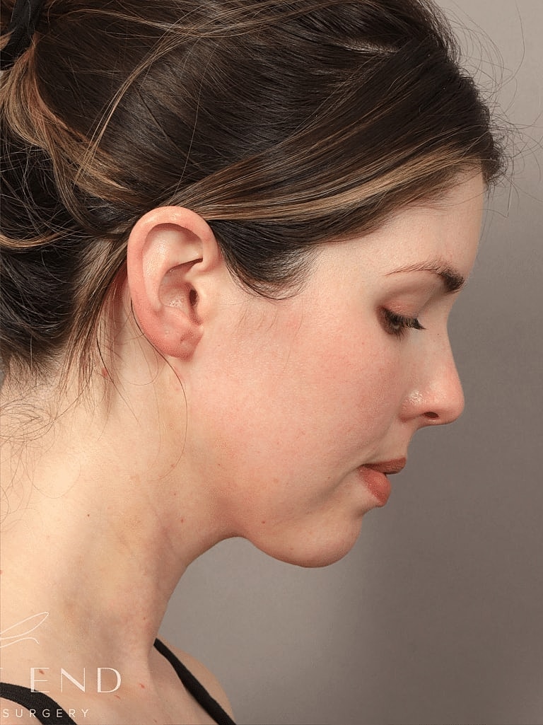 Face Liposuction Before & After