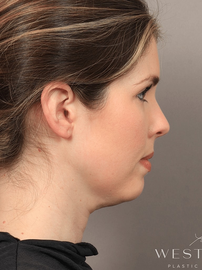 Face Liposuction Before & After