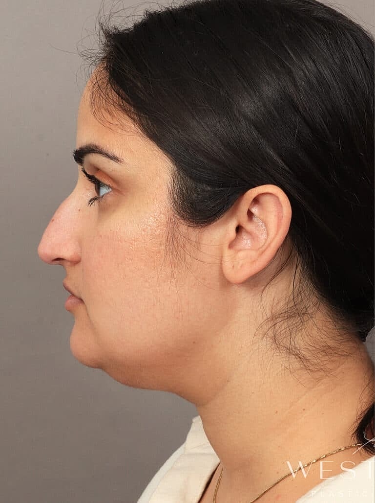 Face Liposuction Before & After