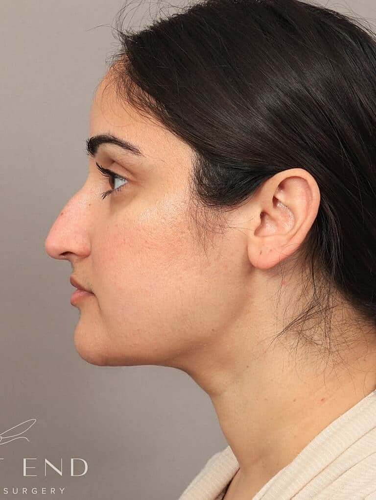 Face Liposuction Before & After
