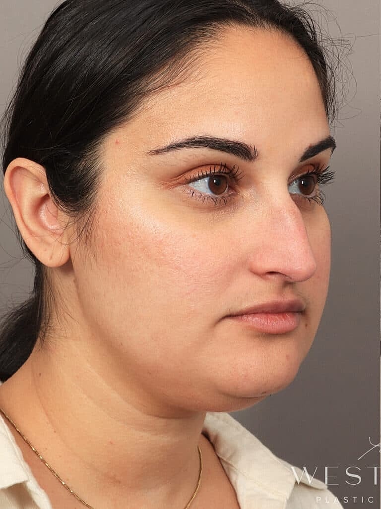 Face Liposuction Before & After