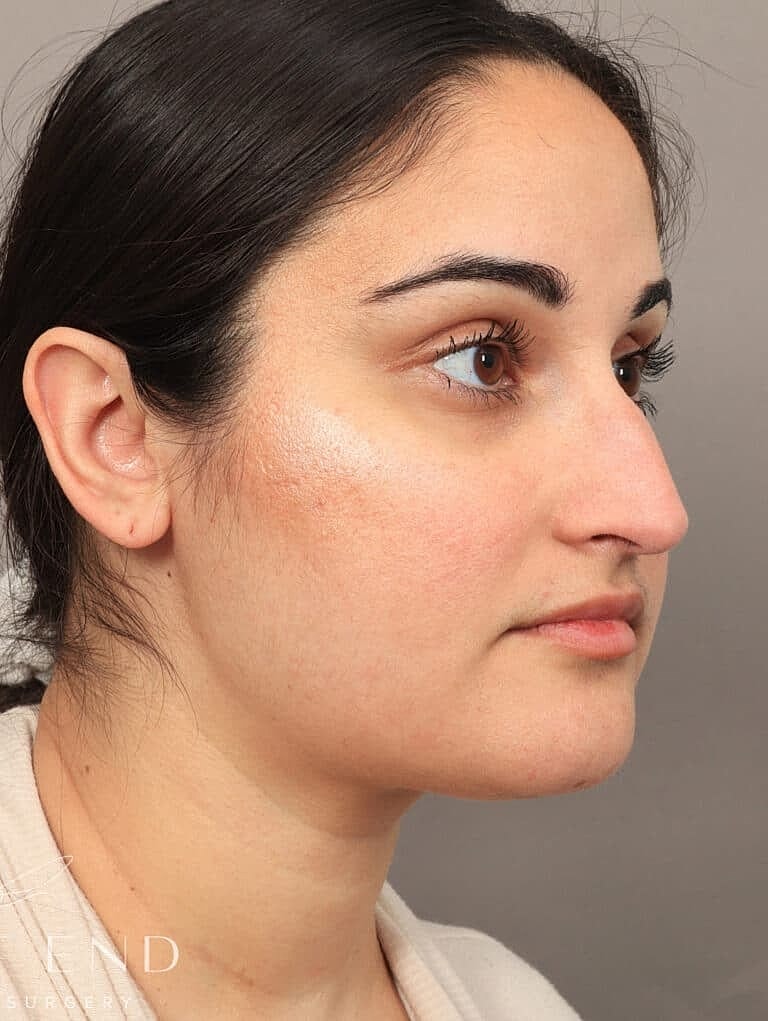 Face Liposuction Before & After