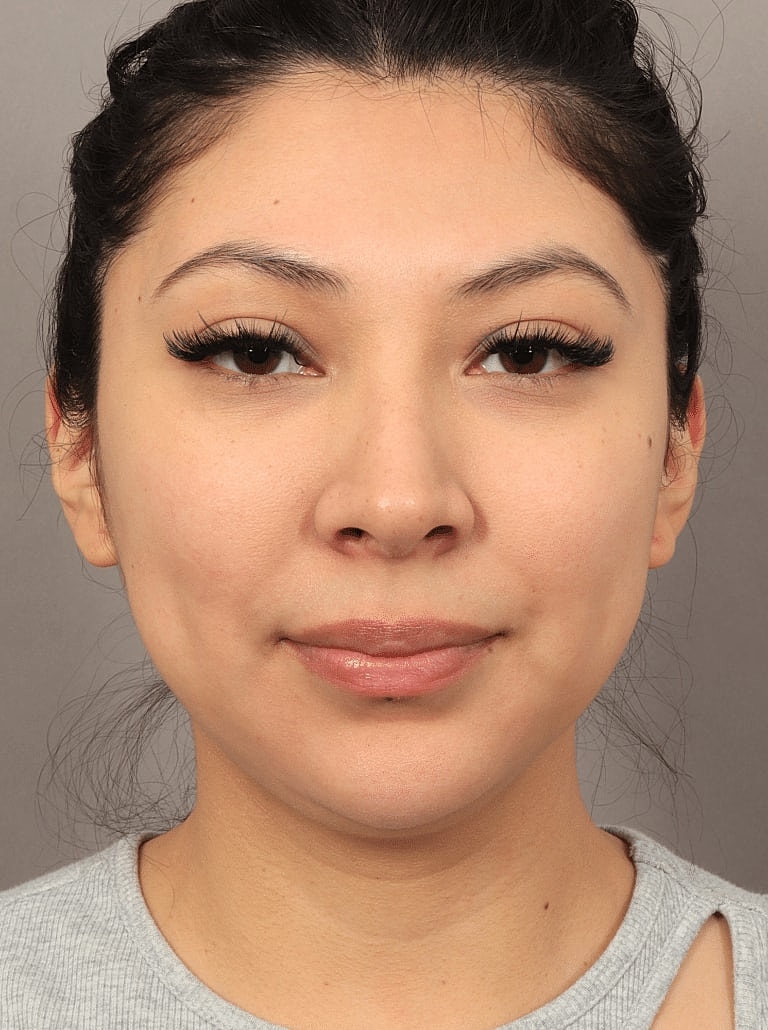 Face Liposuction Before & After