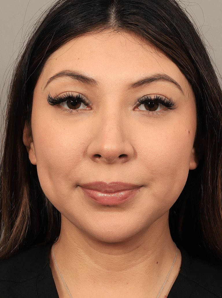 Face Liposuction Before & After