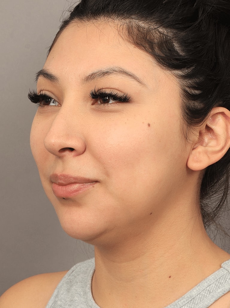 Face Liposuction Before & After