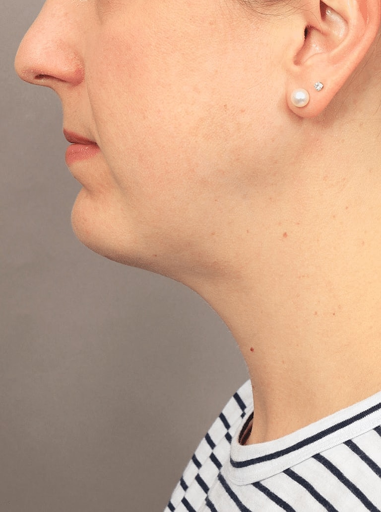 Face Liposuction Before & After