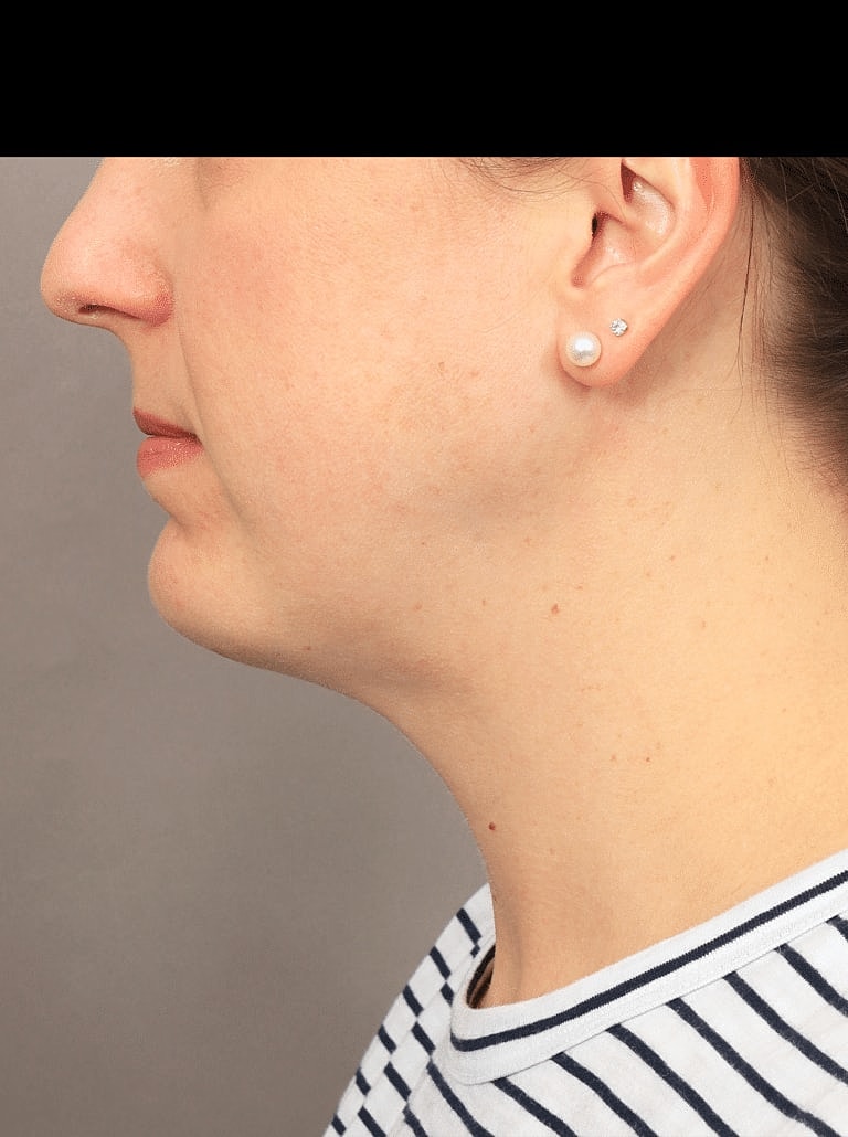 Face Liposuction Before & After