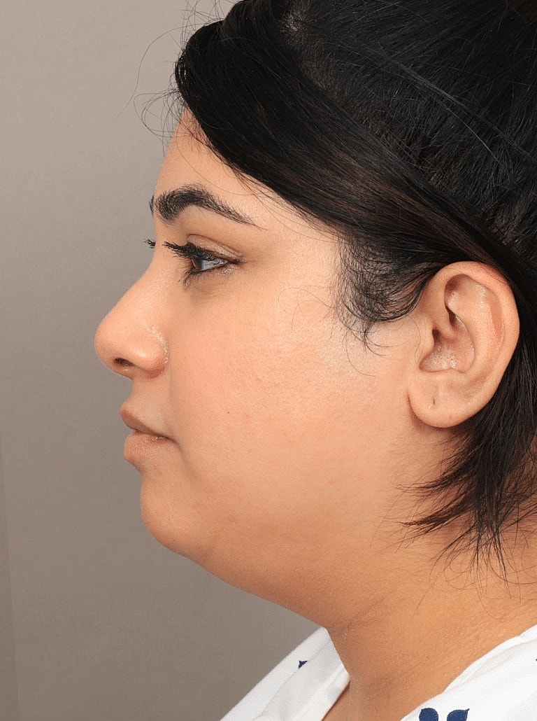 Face Liposuction Before & After