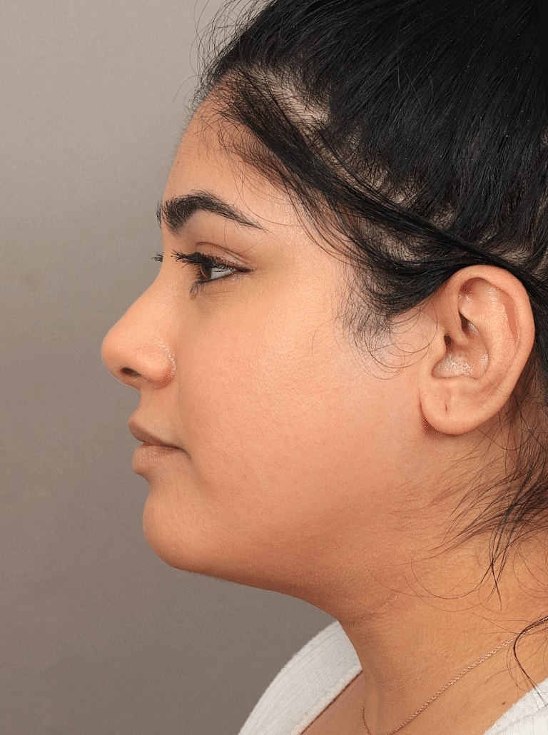 Face Liposuction Before & After