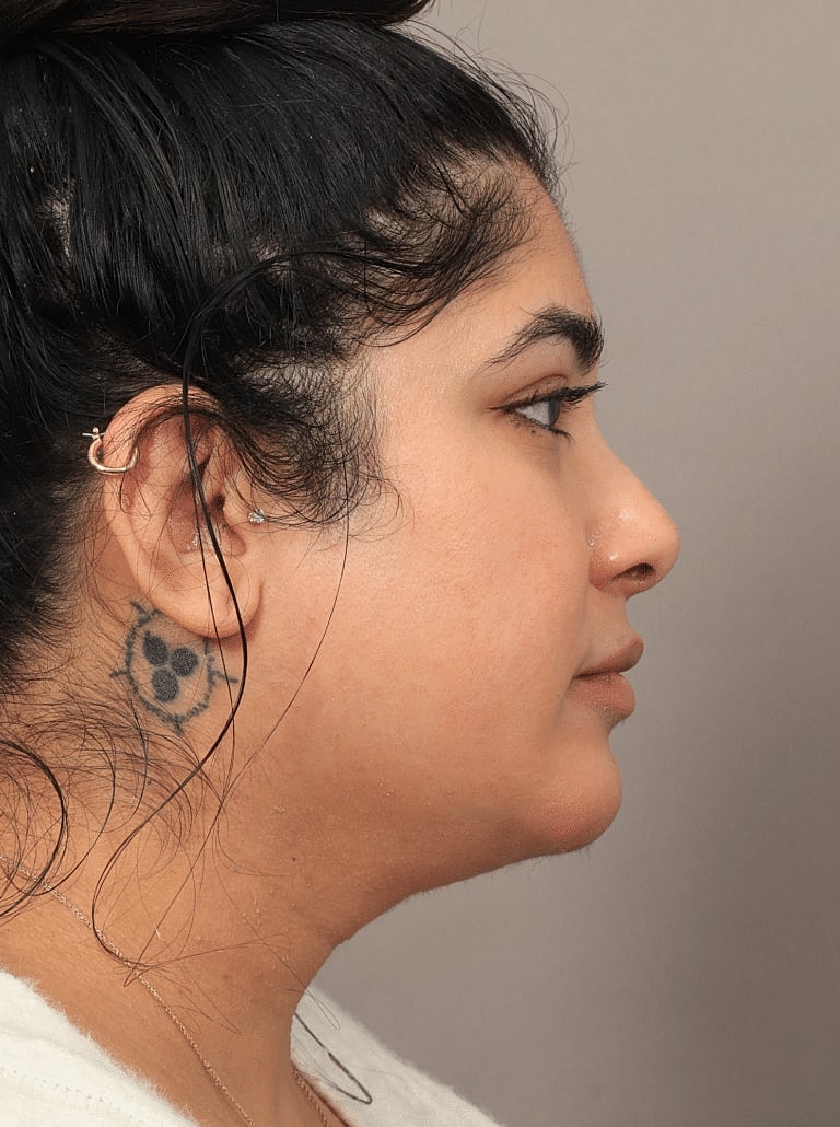 Face Liposuction Before & After