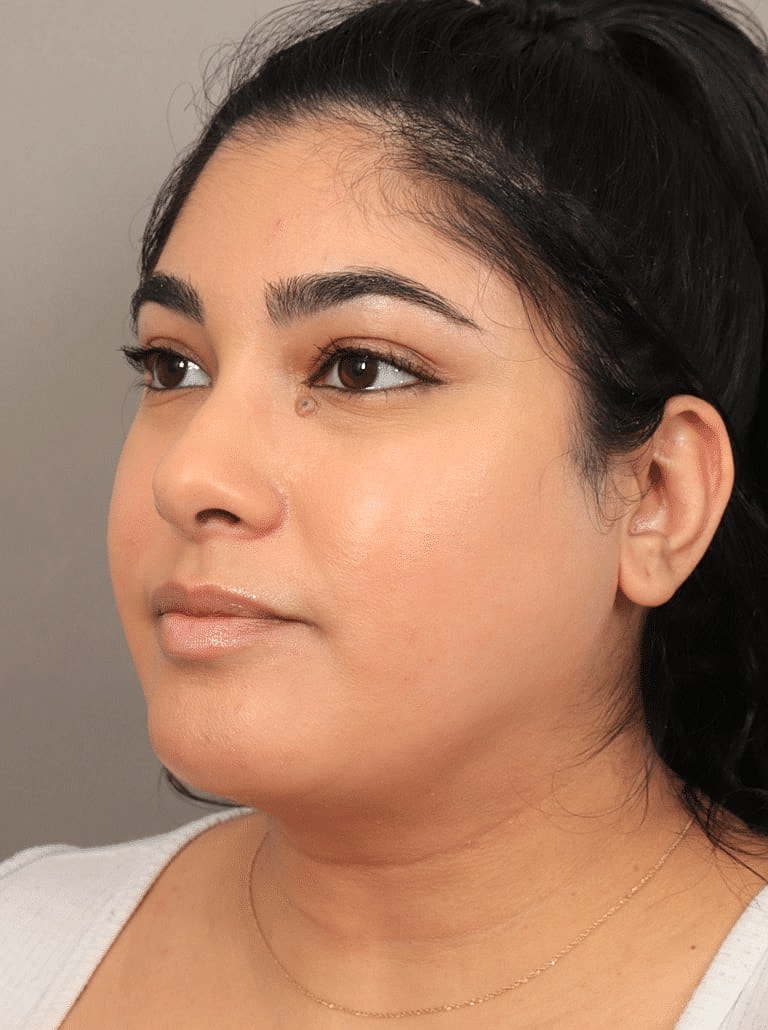 Face Liposuction Before & After