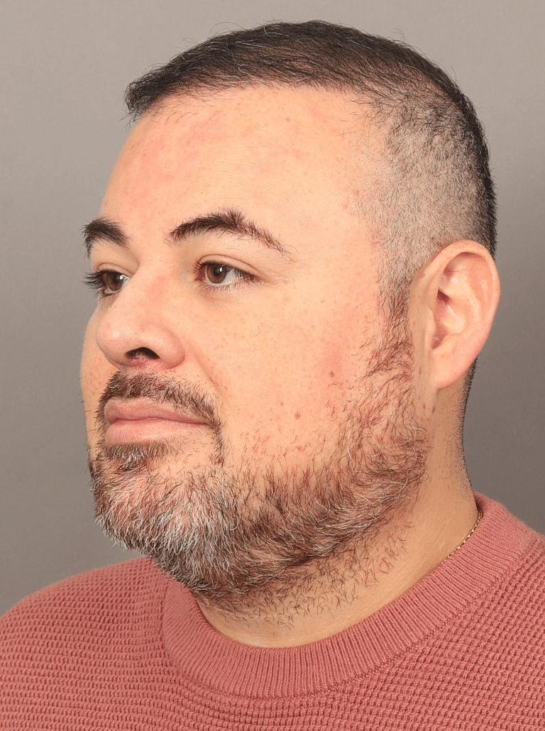 Face Liposuction Before & After