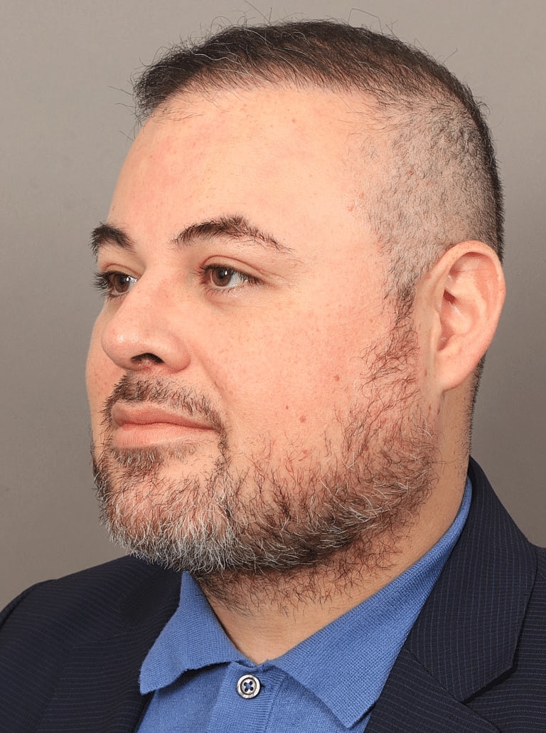 Face Liposuction Before & After