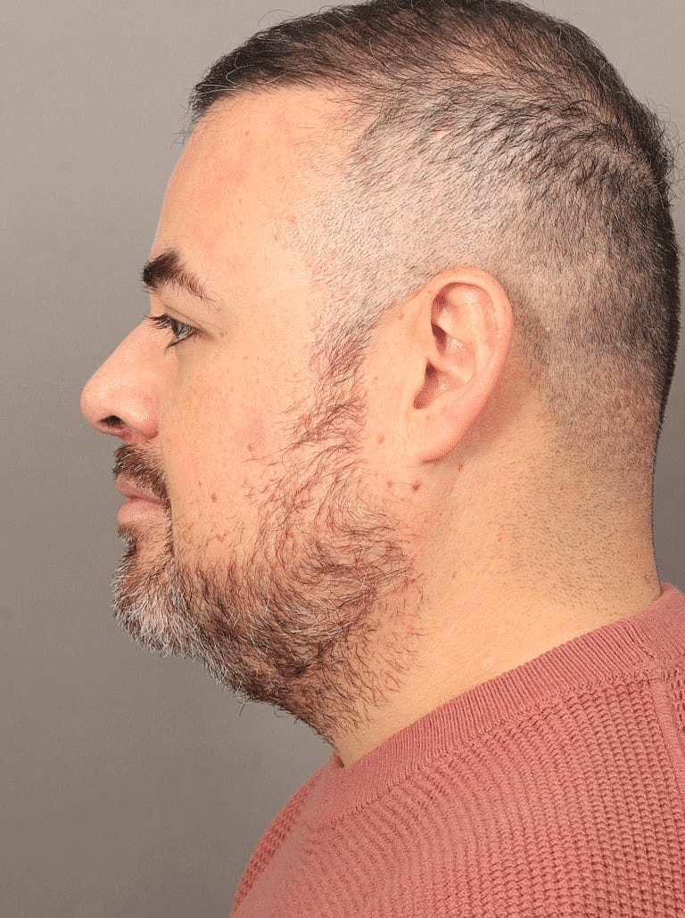 Face Liposuction Before & After