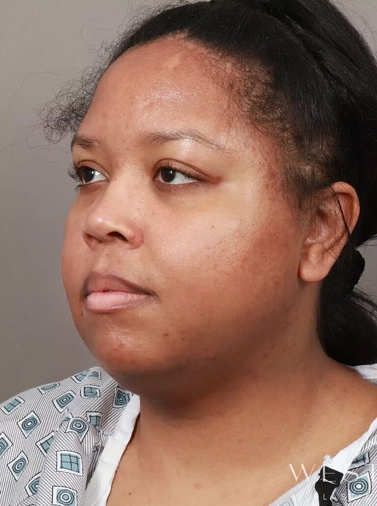 Face Liposuction Before & After