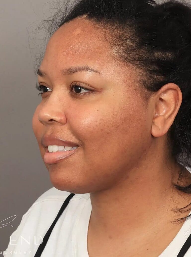 Face Liposuction Before & After