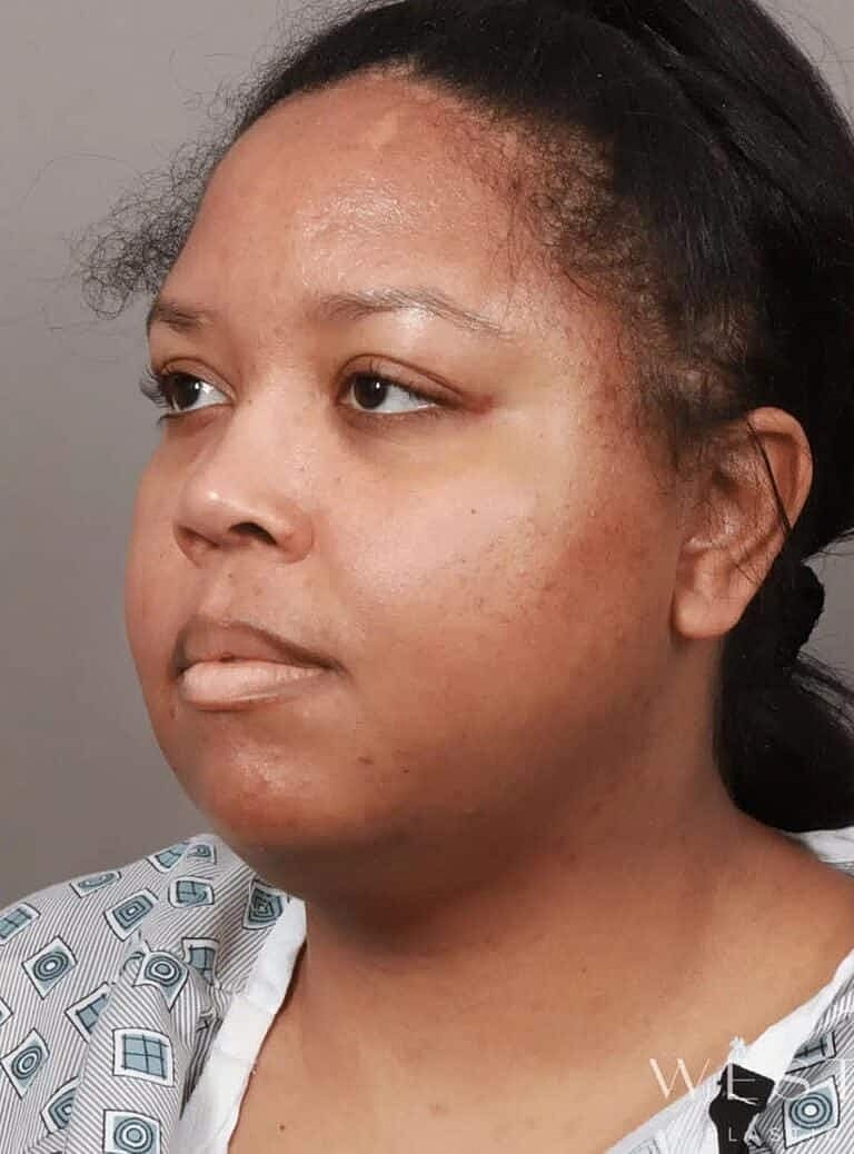 Face Liposuction Before & After