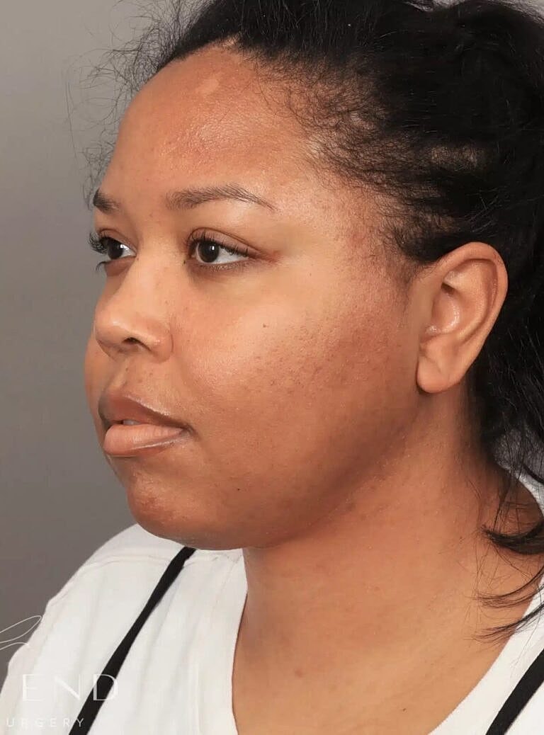 Face Liposuction Before & After