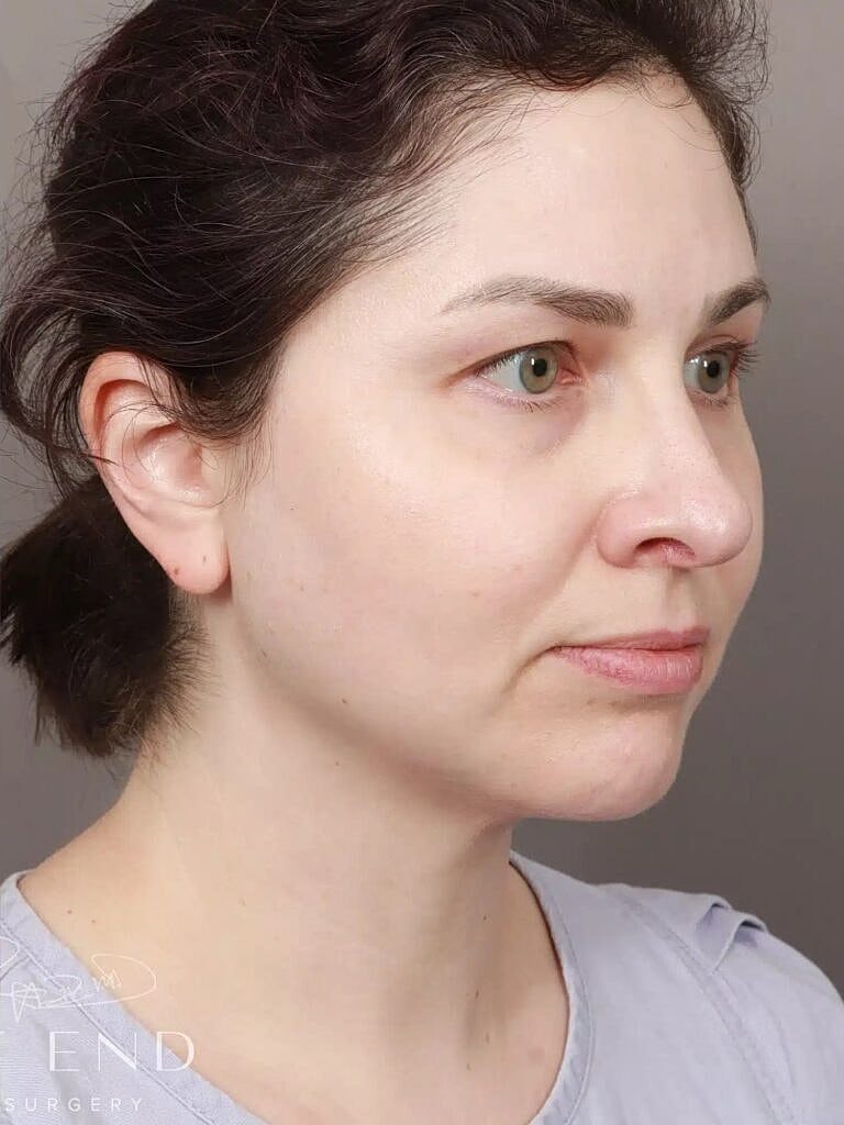 Face Liposuction Before & After