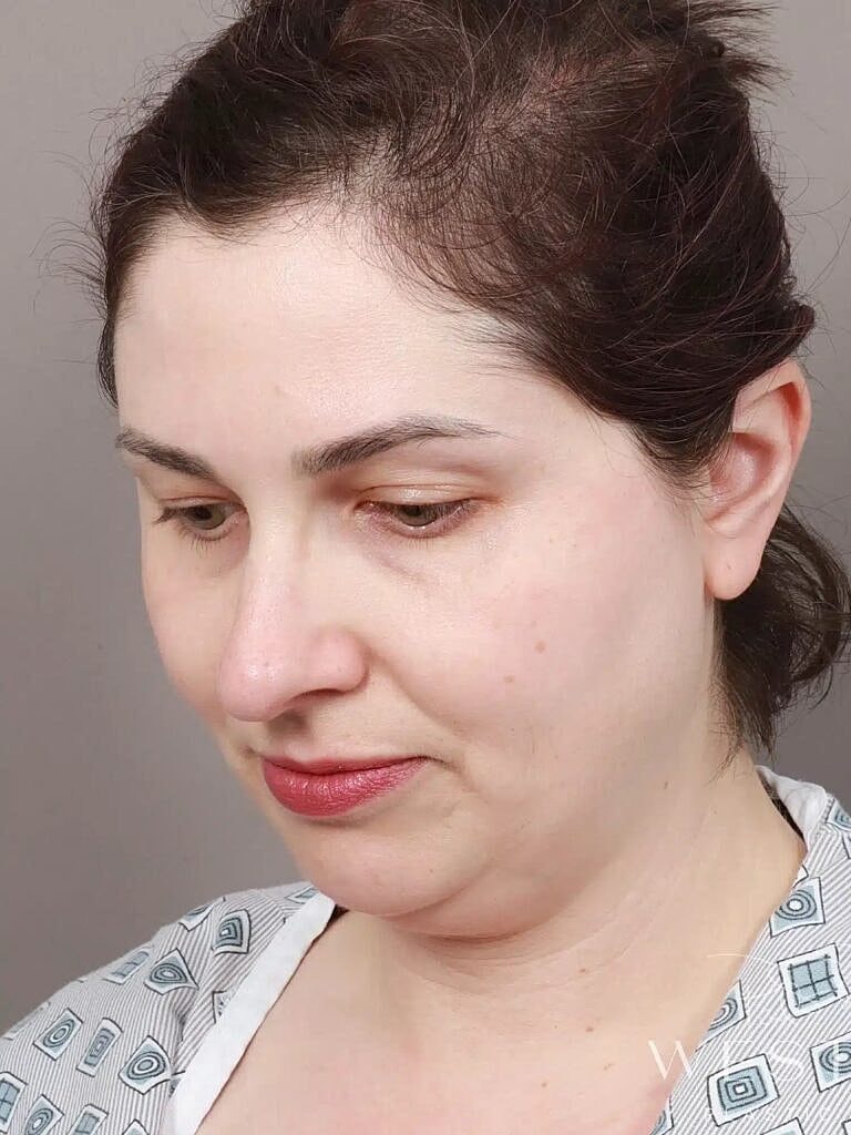 Face Liposuction Before & After