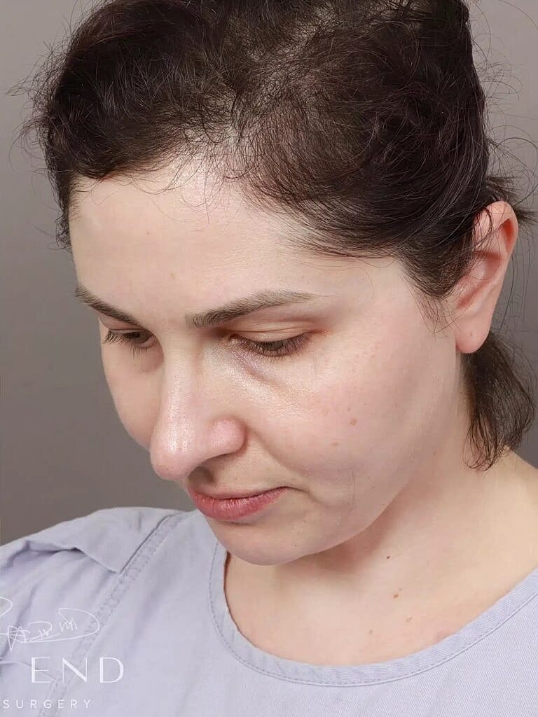 Face Liposuction Before & After