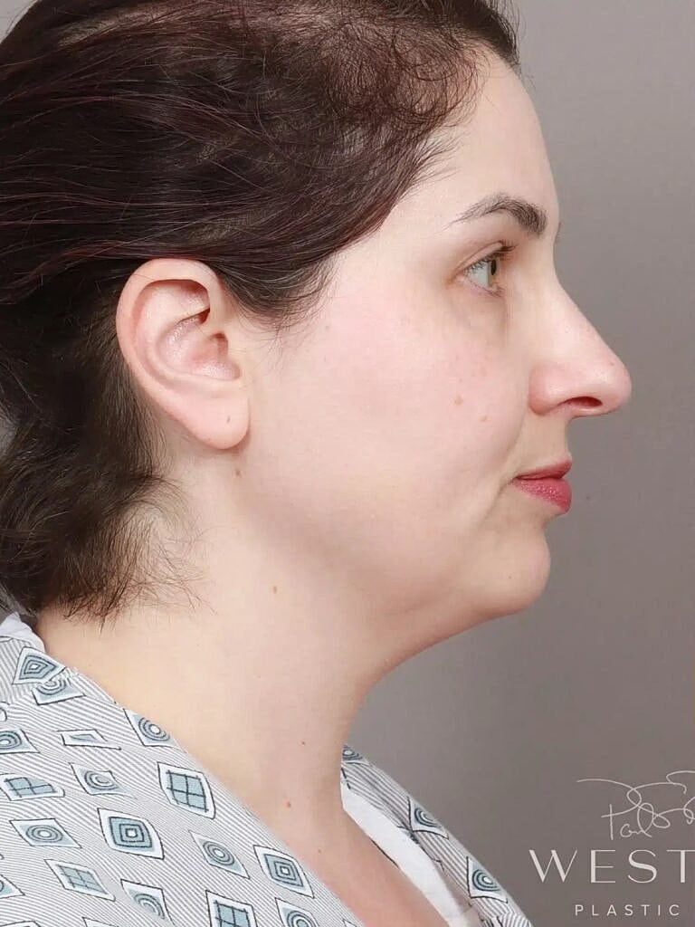 Face Liposuction Before & After