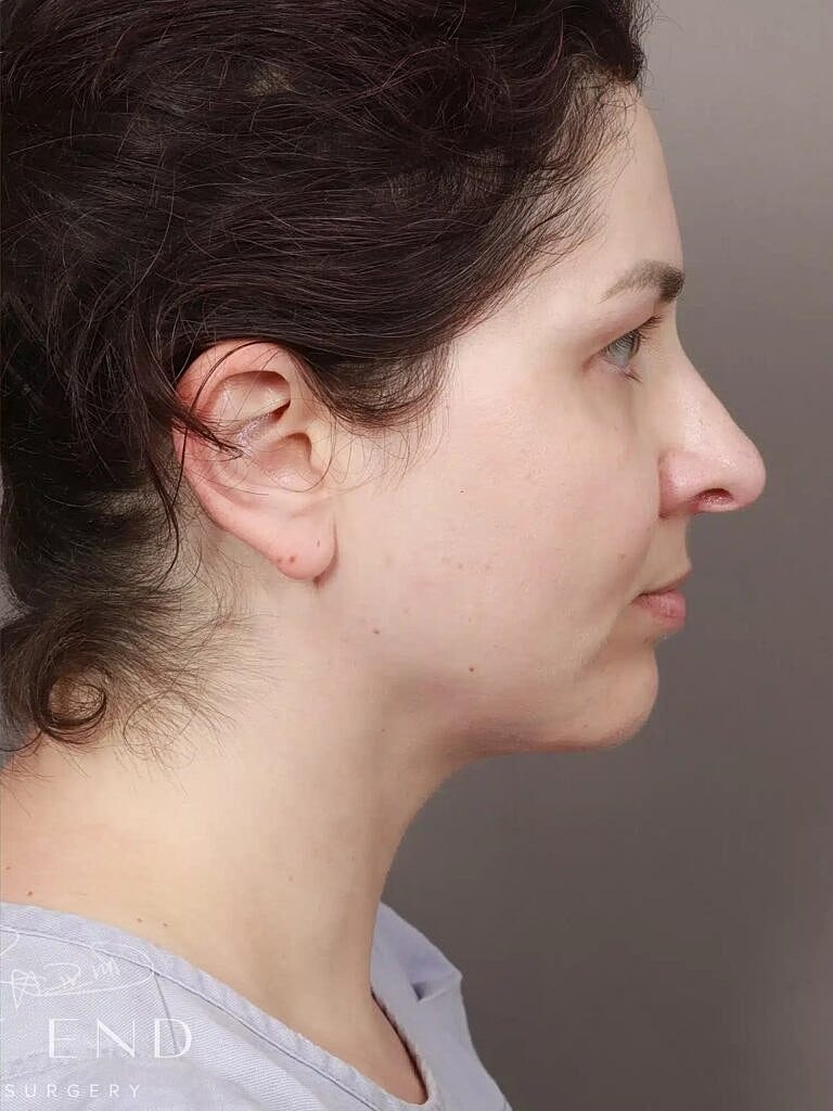 Face Liposuction Before & After