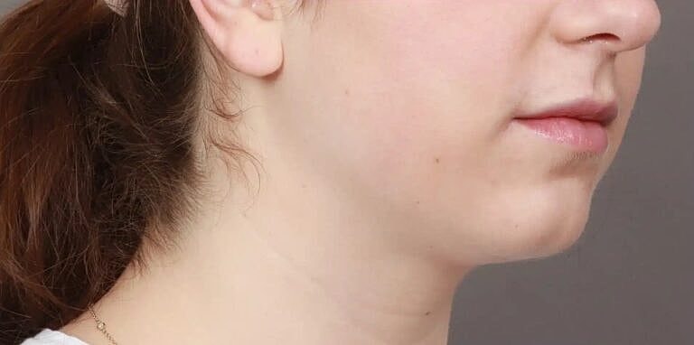 Face Liposuction Before & After