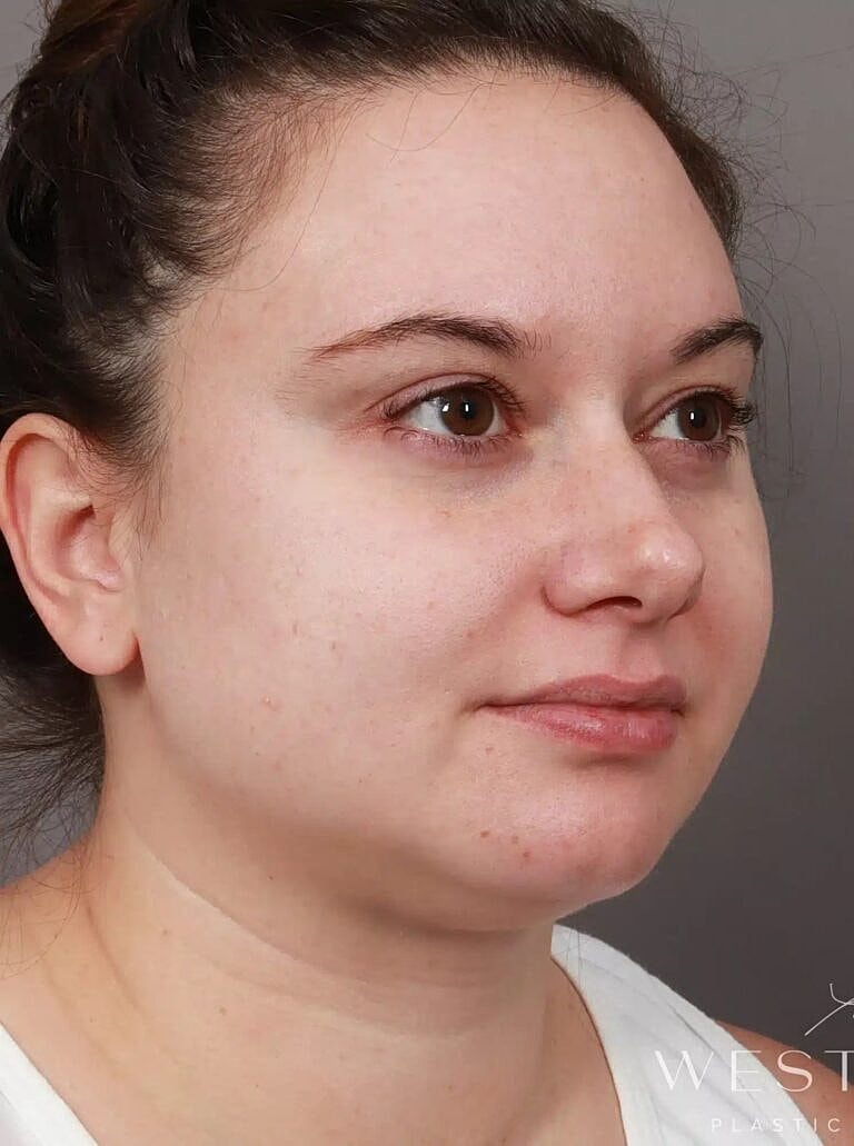 Face Liposuction Before & After